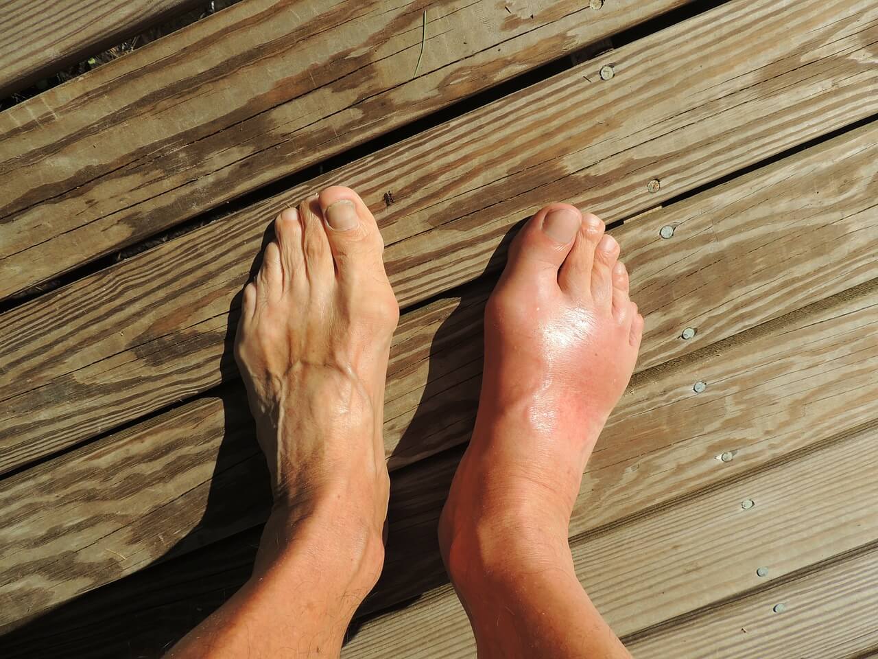 The Real Reason Your Uric Acid Won't